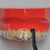 Aligner Removal Tool Use 001