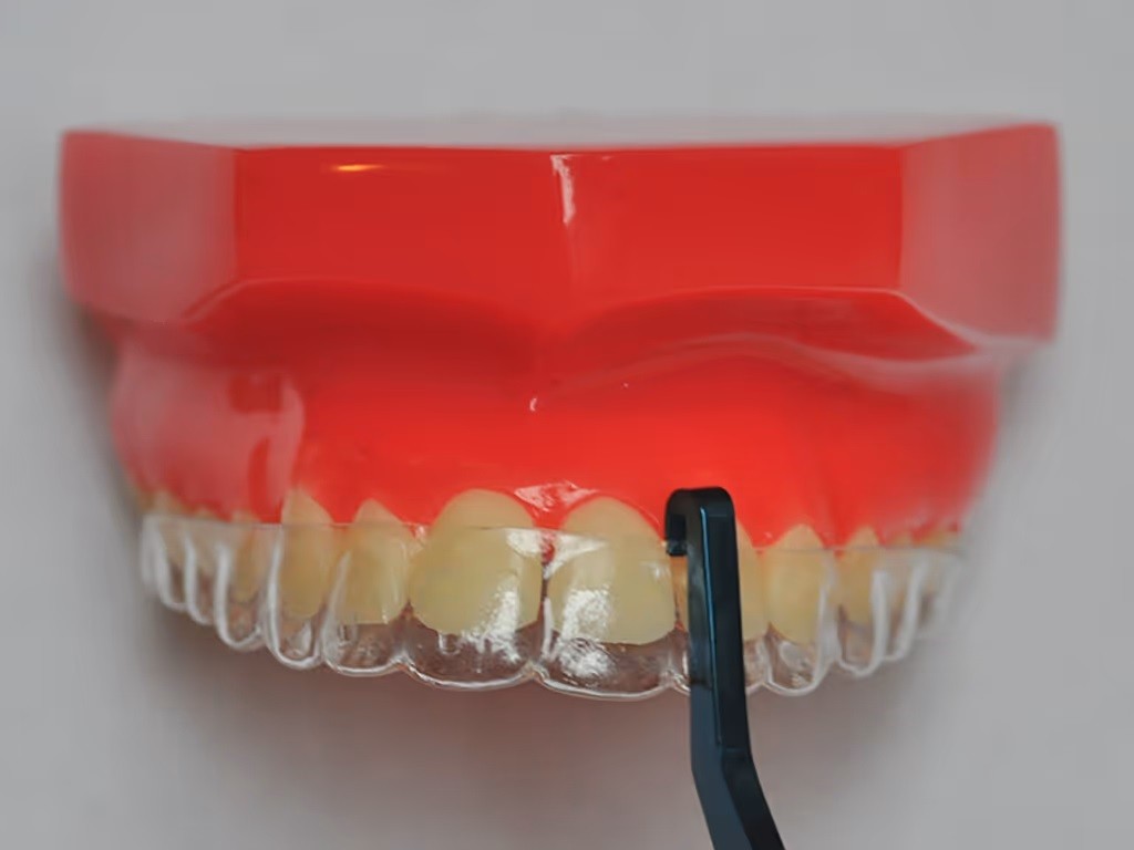 Aligner Removal Tool Use 001