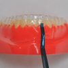 Aligner Removal Tool Use 002
