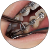 Ligature Tweezer Work